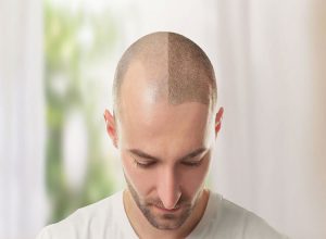 پروتز مو برای چه افرادی مناسب است