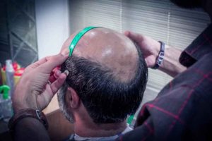 نکات مهم درباره ی پروتز مو