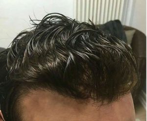 تفاوت پروتز مو با کلاه گیس